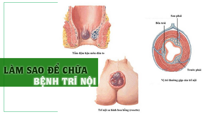 Chữa trị nội - Điều trị trĩ nội