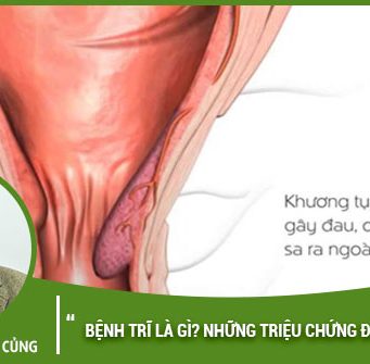 Bệnh Trĩ là gì? Các triệu chứng của bệnh trĩ bạn cần biết