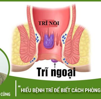 Hiểu bệnh trĩ là gì để biết cách phòng tránh trĩ hiệu quả