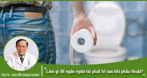 Làm gì để ngăn ngừa tái phát trĩ sau khi phẫu thuật?