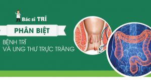 Phân biệt bệnh trĩ và ung thư trực tràng