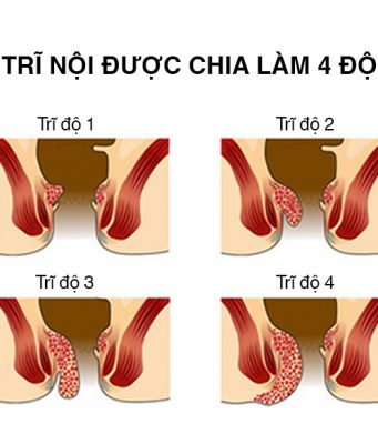 bệnh trĩ nội và 4 cấp độ trĩ nội thường gặp