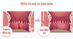 nứt kẻ hậu môn và cách điều trị