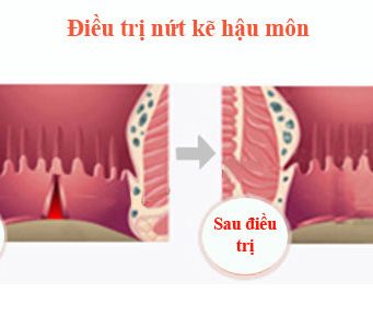 nứt kẻ hậu môn và cách điều trị