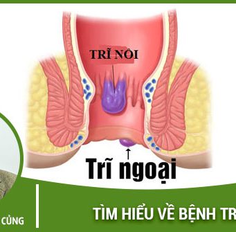 bệnh trĩ ngoại là gì