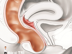 sa trực tràng kiểu túi ở phụ nữ