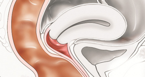 sa trực tràng kiểu túi ở phụ nữ