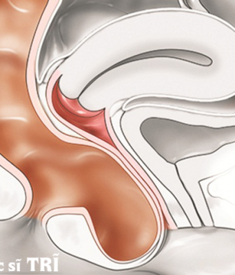 sa trực tràng kiểu túi ở phụ nữ